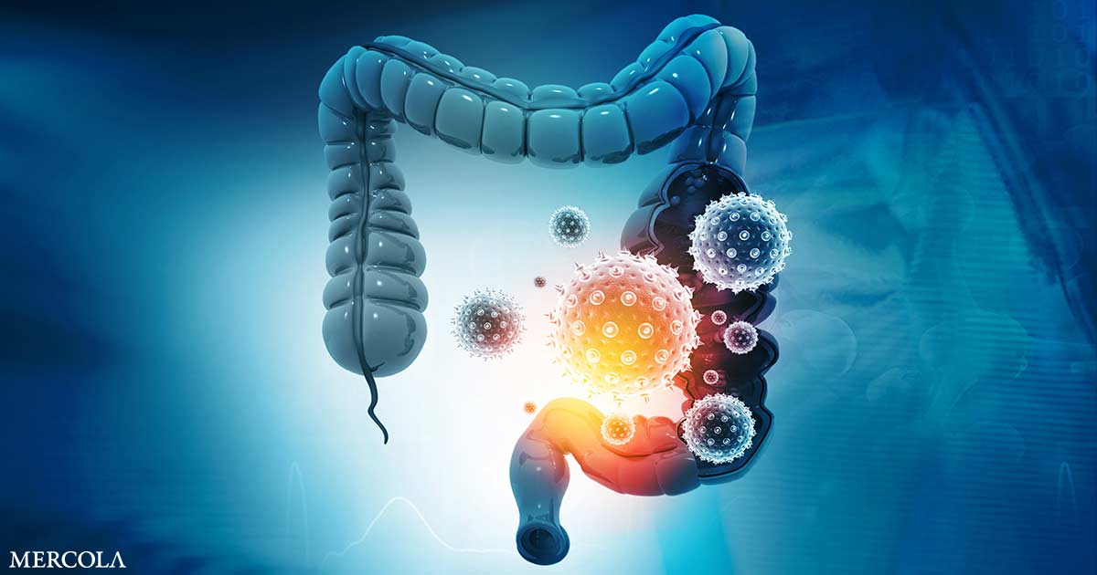 Vitamin D Helps Decrease Your Threat of Colorectal Most cancers