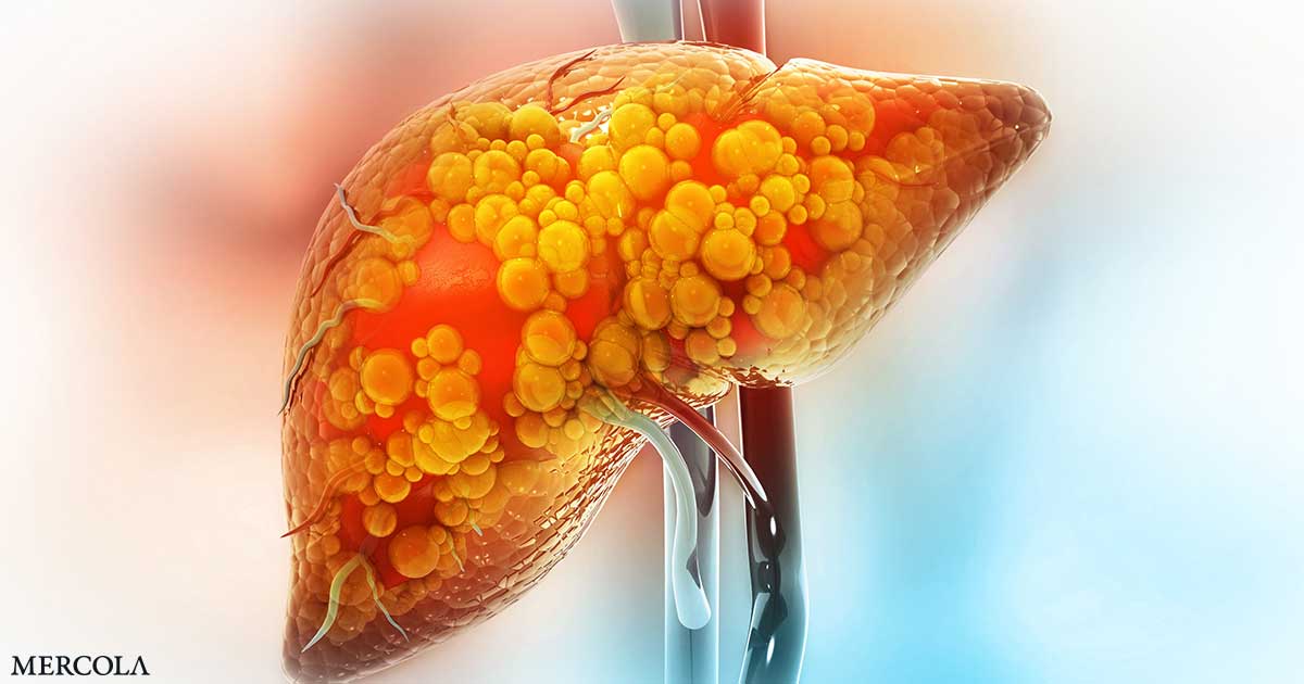 Krill Oil Attenuates Fatty Liver and Oxidative Stress in Obesity