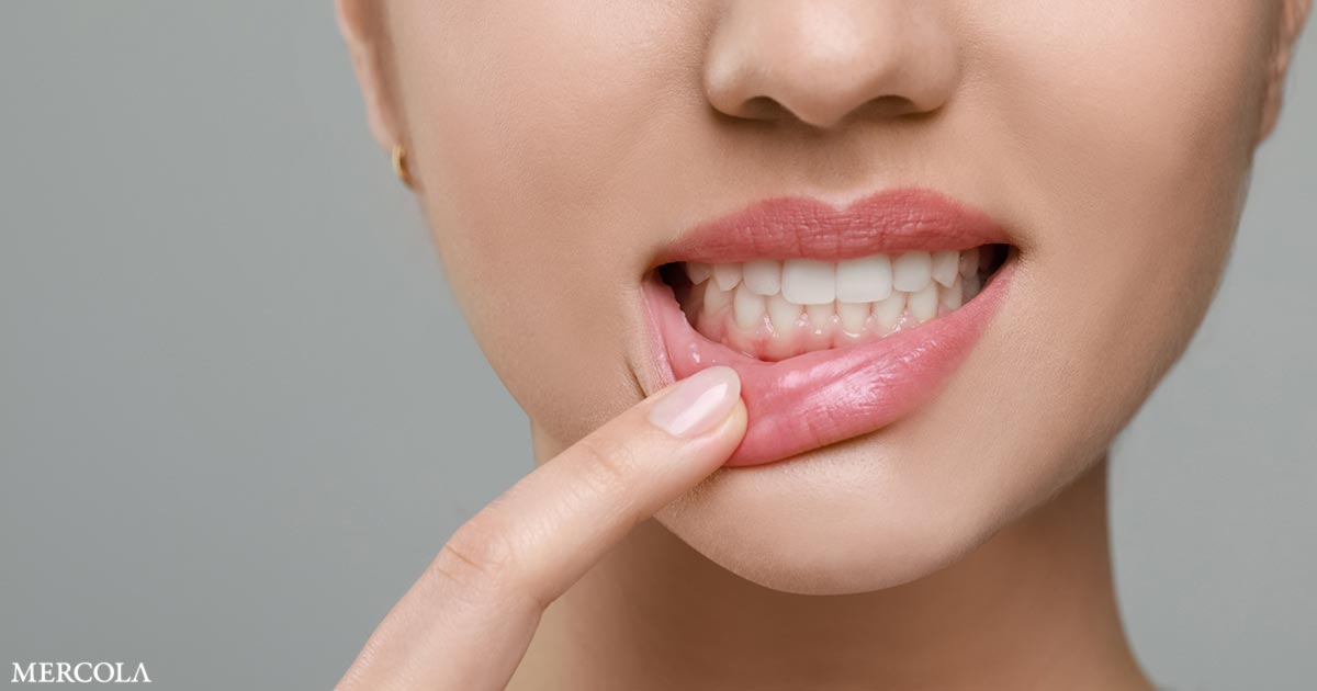 Gum Disease Bacterium Linked to Increased Risk of Atrial Fibrillation