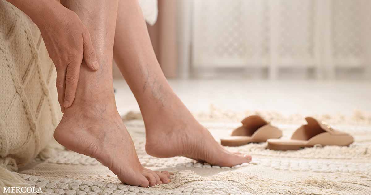 Varicose Veins Are More Than a Cosmetic Concern