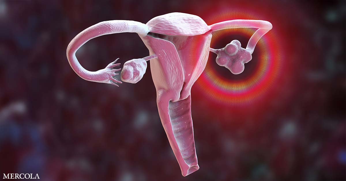 What to Do if You Get Recognized with an Ovarian Cyst