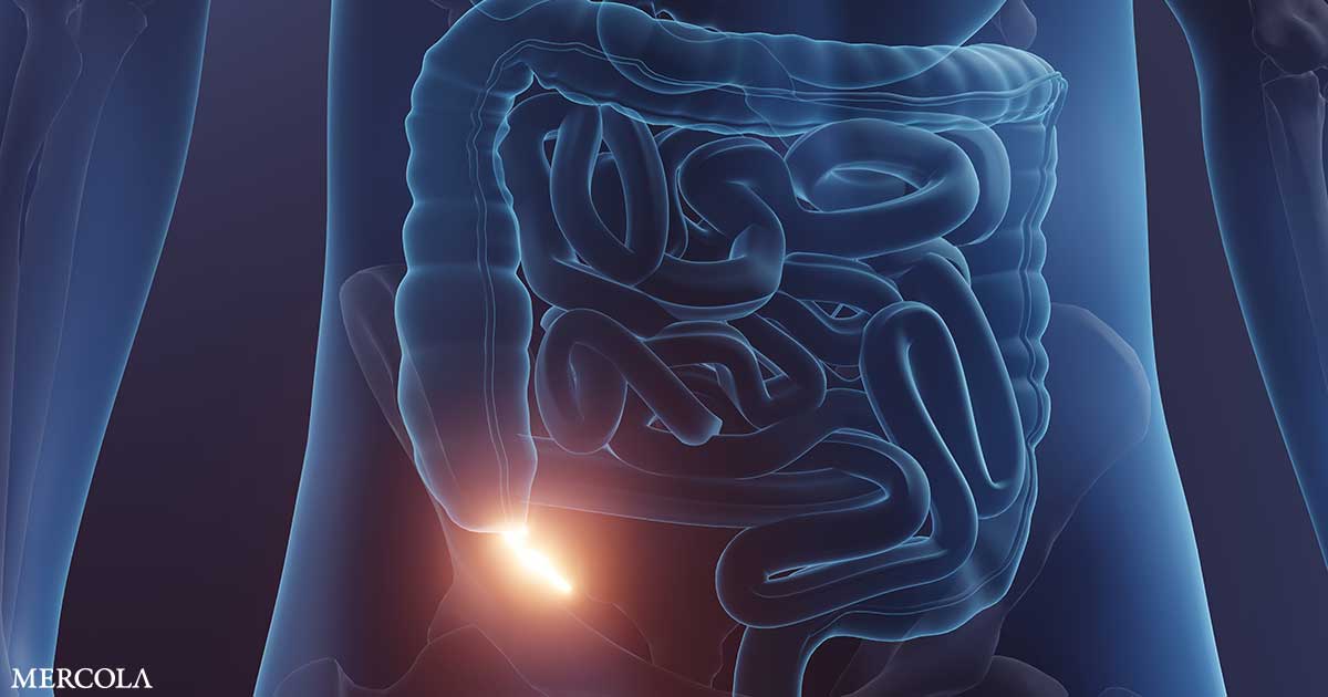 Appendix Cancer Is on the Rise Among Younger Generations