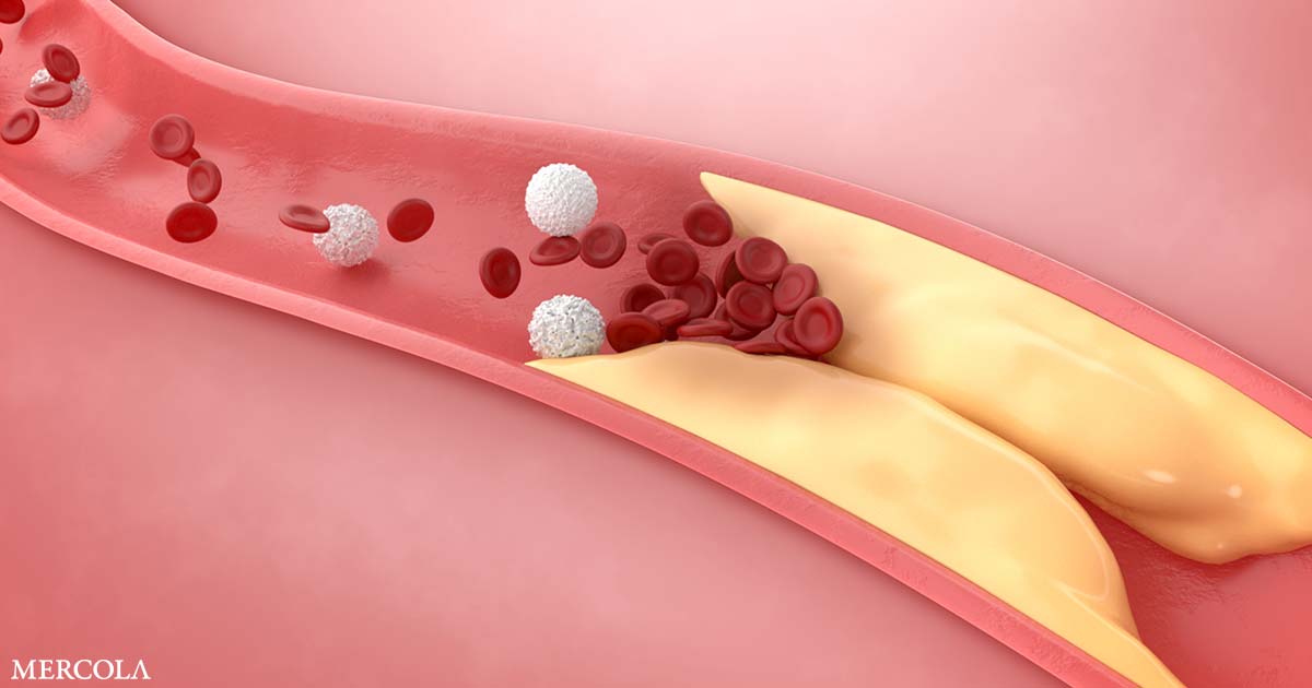 Heart Scan Study Finds Low-Fiber Diets Raise Risk of Dangerous Artery Plaque