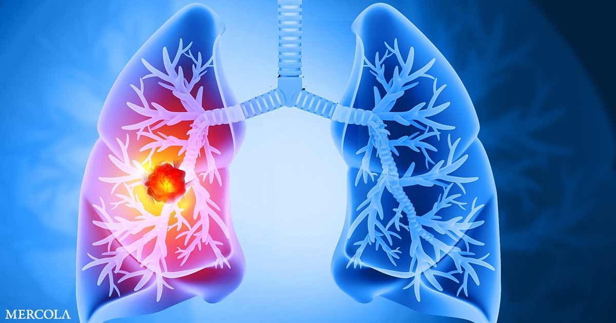 Processed Food Diet Raises Lung Cancer Risk