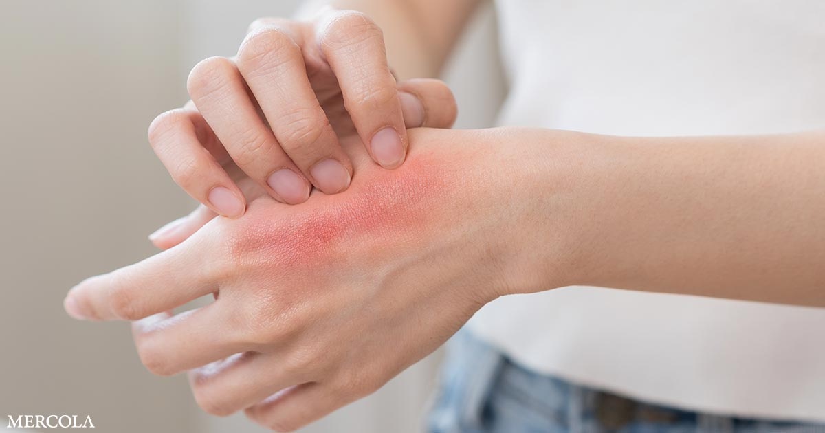 Understanding Hand Dermatitis and How to Heal It Naturally