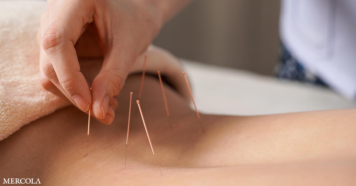 Exploring Acupuncture as a Time-Tested Option for Chronic Low Back Pain