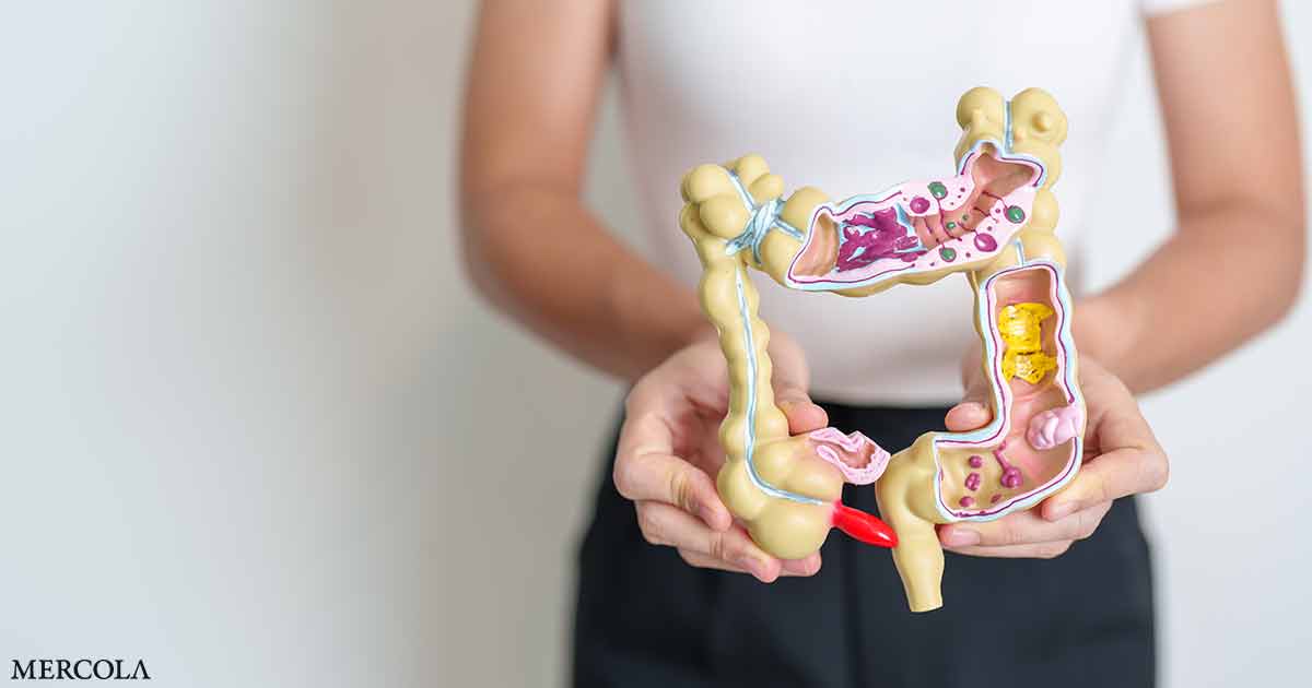 Severe Diverticulitis Is Rising Rapidly Among Younger Adults