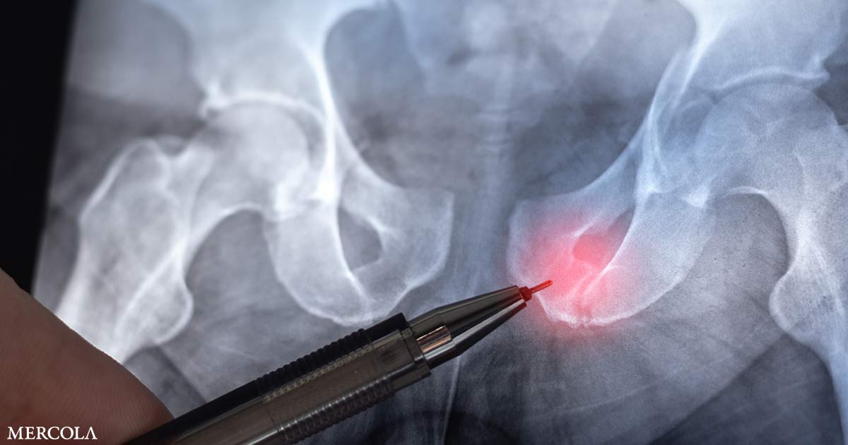 Hip Fractures from Osteoporosis Predicted to Double by 2050